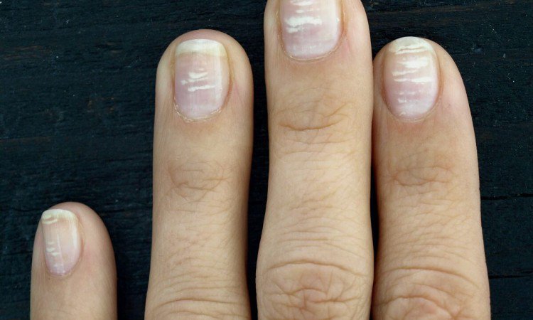 Białe plamki na paznokciach: czemu się pojawiają? Objawy i przyczyny powstawania - zdjęcie