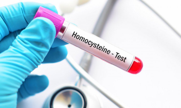 Homocysteina – jakie są normy w badaniu krwi? Problem z wysokim poziomem homocysteiny. - zdjęcie