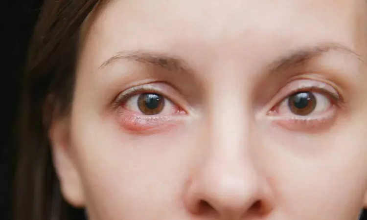 Jęczmień na oku: objawy, przyczyny oraz leczenie. Czy istnieją domowe sposoby na jęczmień? - zdjęcie