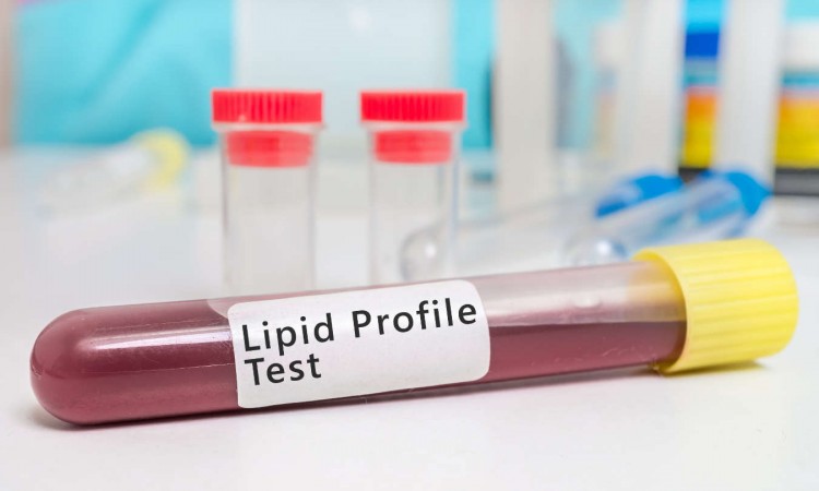 Lipidogram – przygotowanie, normy i interpretacja wyników. Ile kosztuje badanie lipidogramu? - zdjęcie