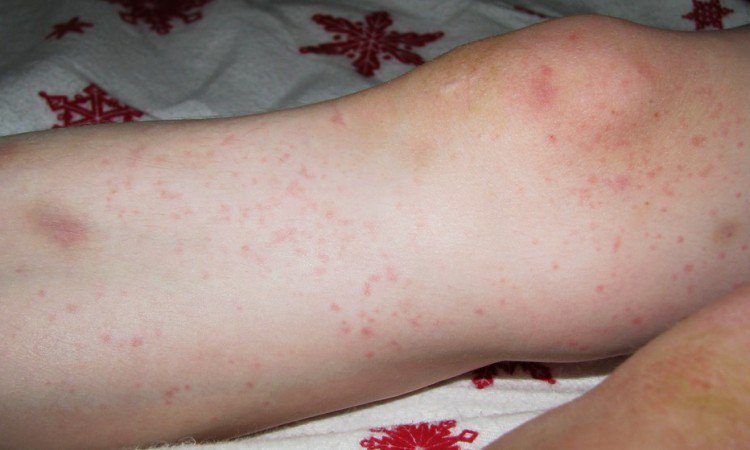 Mononukleoza zakaźna – jakie są objawy i leczenie?