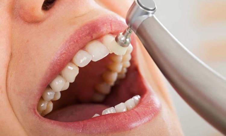 Skaling zębów – kiedy warto zainteresować się usuwaniem kamienia nazębnego? - zdjęcie