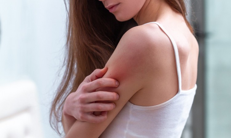 Wysypka alergiczna na ciele: sposoby na łagodzenie objawów alergii skórnych - zdjęcie